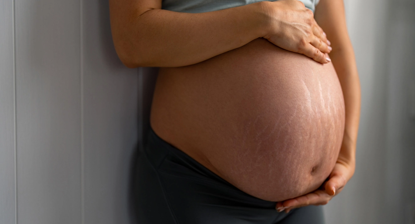 Dehnungsstreifen vorbeugen in der Schwangerschaft: Ursachen & Pflege Schwangere Frau mit Schwangerschaftsstreifen am Bauch – Tipps, um Dehnungsstreifen vorbeugen zu können