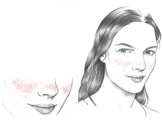 Illustration einer Frau mit geröteten, entzündeten Hautstellen auf den Wangen, typisch für Rosazea