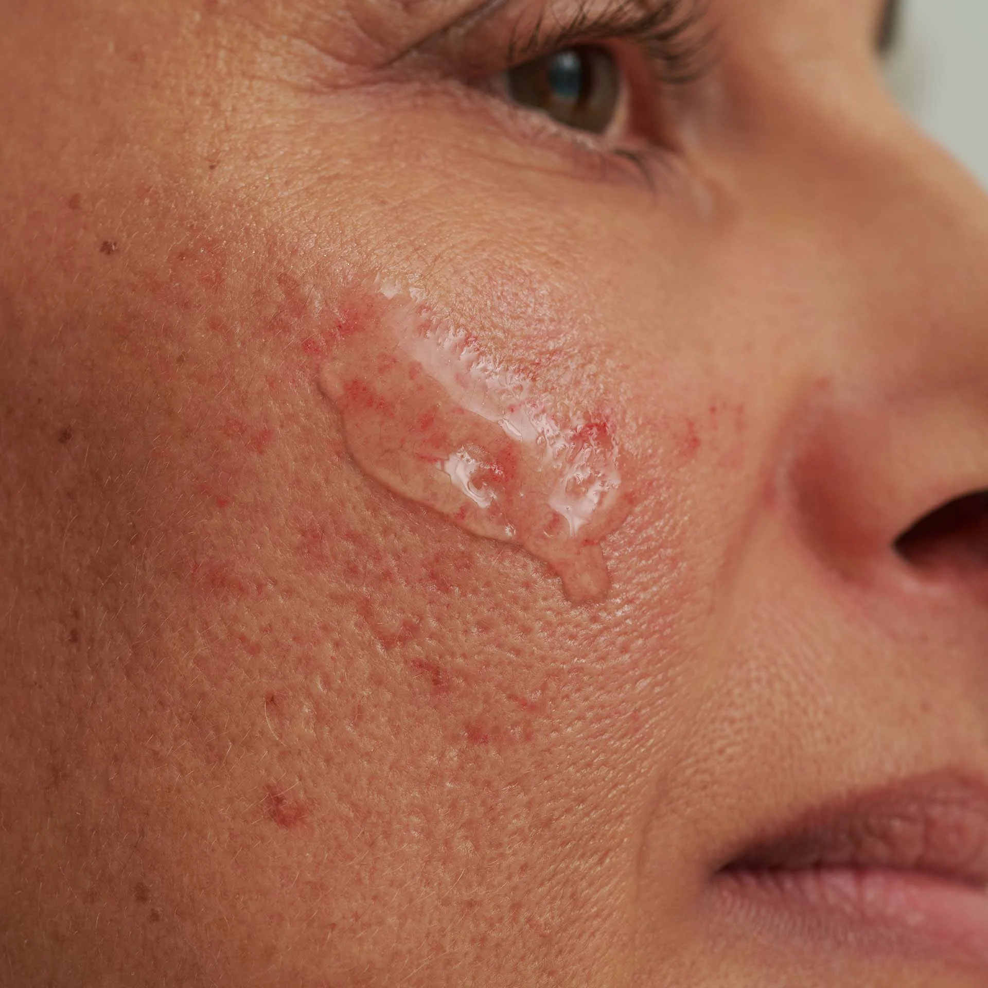 DADO SENS SENSACEA Intensivserum auf geröteter, gereizter Gesichtshaut mit sichtbarer Gel-Textur