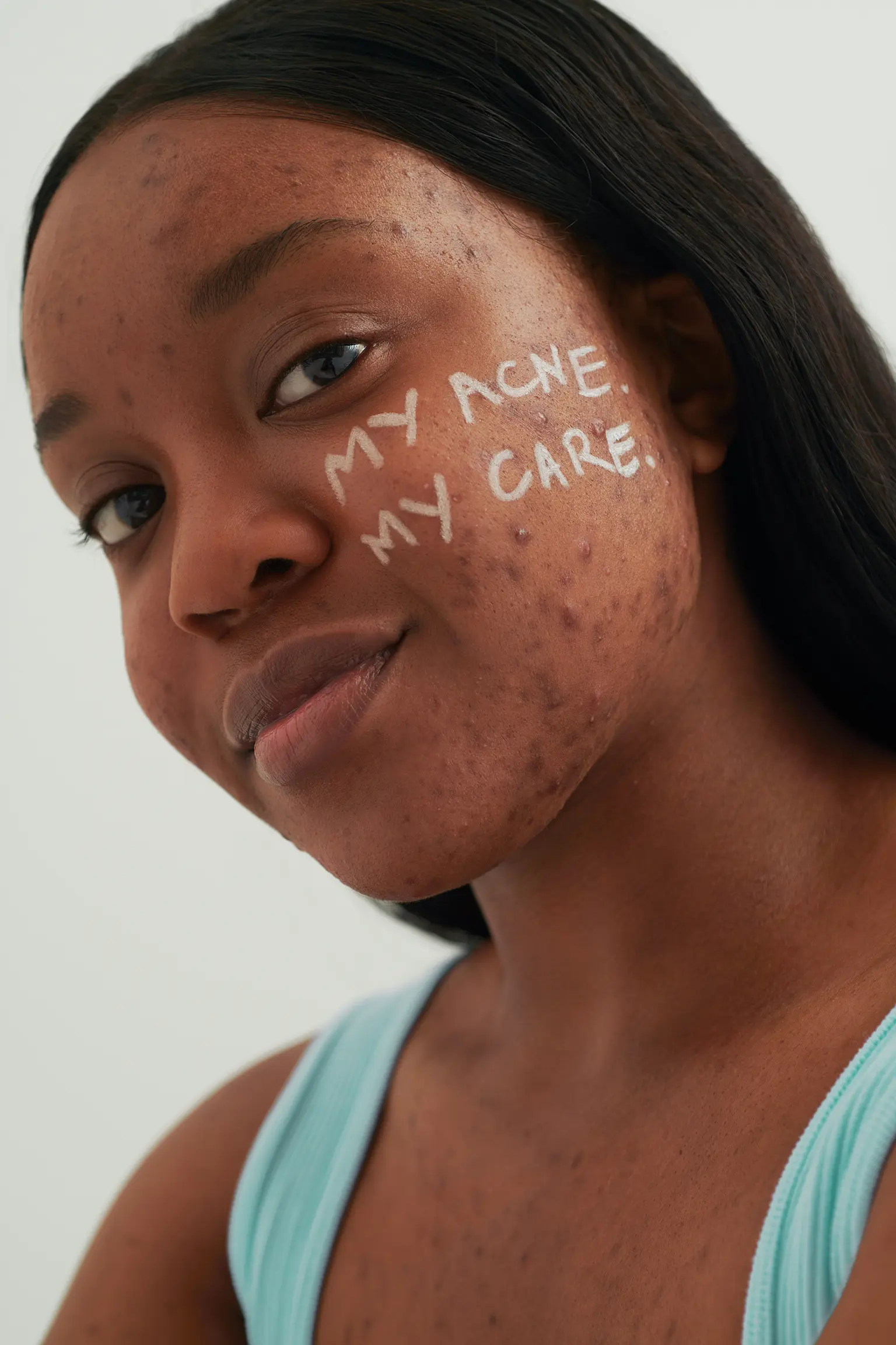 Porträt einer Frau mit Akne, auf der Wange steht in weißer Schrift „MY ACNE. MY CARE.“
