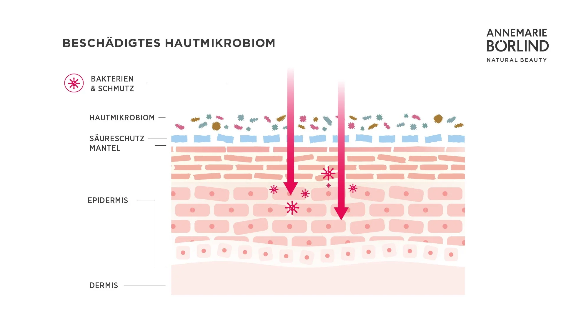 Geschädigtes Mikrobiom der Haut Schematische Darstellung eines beschädigten Hautmikrobioms mit eindringenden Bakterien und Schmutz in die Epidermis