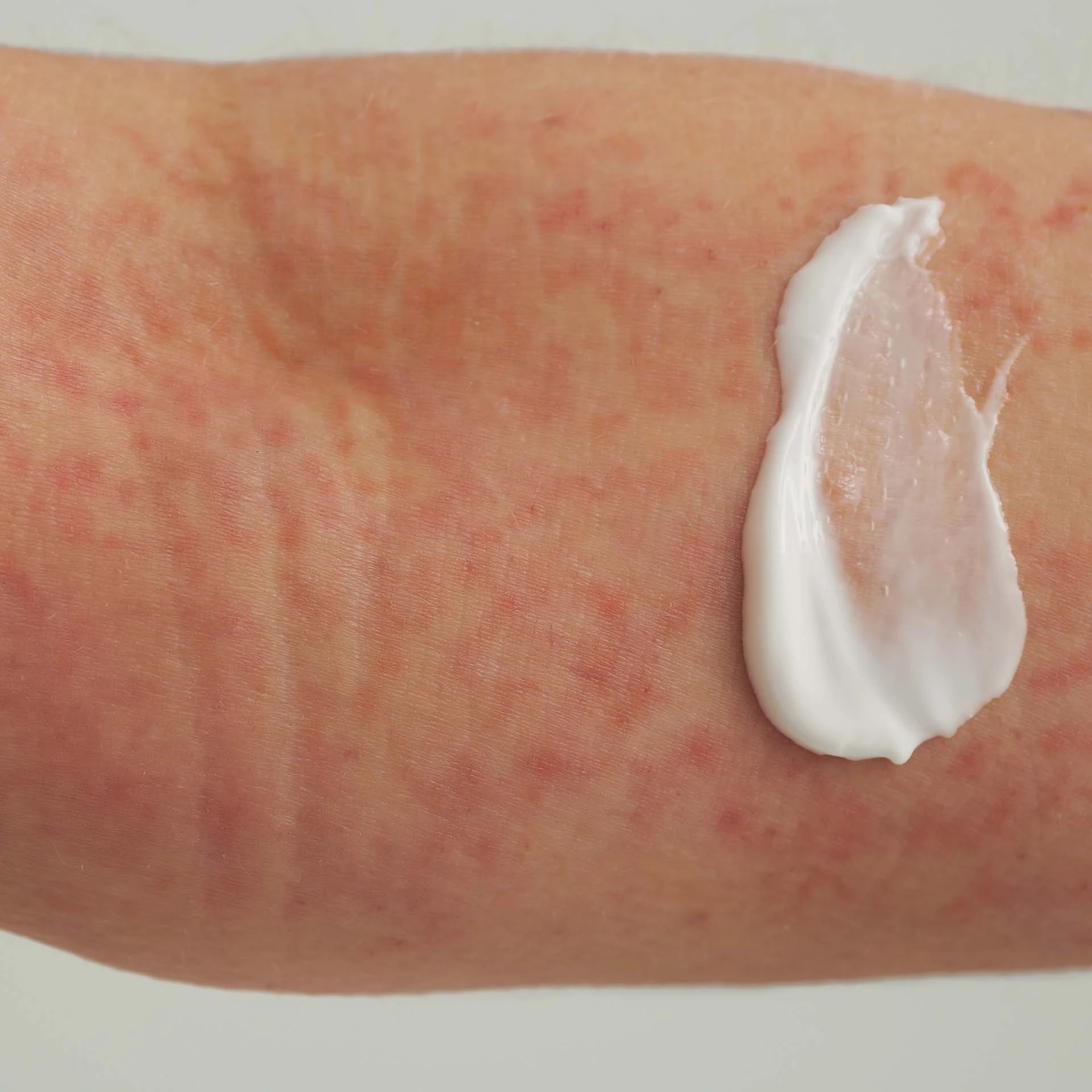 Nahaufnahme eines Arms mit geröteter, gereizter Haut und aufgetragener weißer Creme-Textur