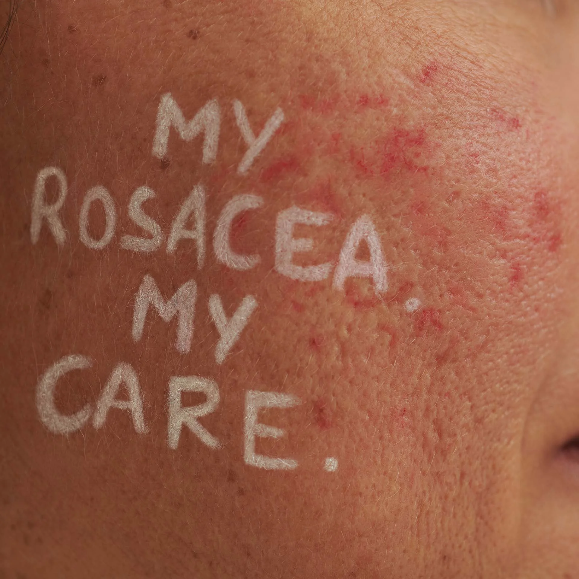 Nahaufnahme von geröteter Haut mit entzündlichen Stellen und weißer Schrift "MY ROSACEA MY CARE" auf der Wange