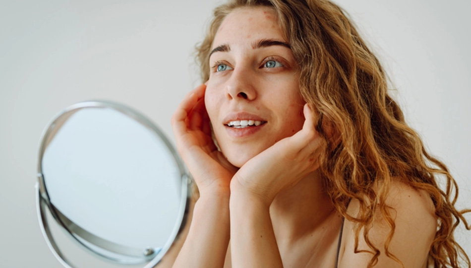 When your skin is not cooperating: tips for calming irritated skin Young woman with blemished skin looking in the mirror – when your skin is not cooperating
