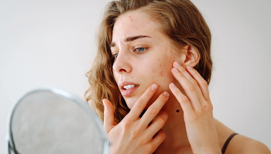 Naturkosmetik Unreine Haut Frau betrachtet besorgt ihre unreine Haut mit Pickeln und Rötungen im Spiegel, Nahaufnahme