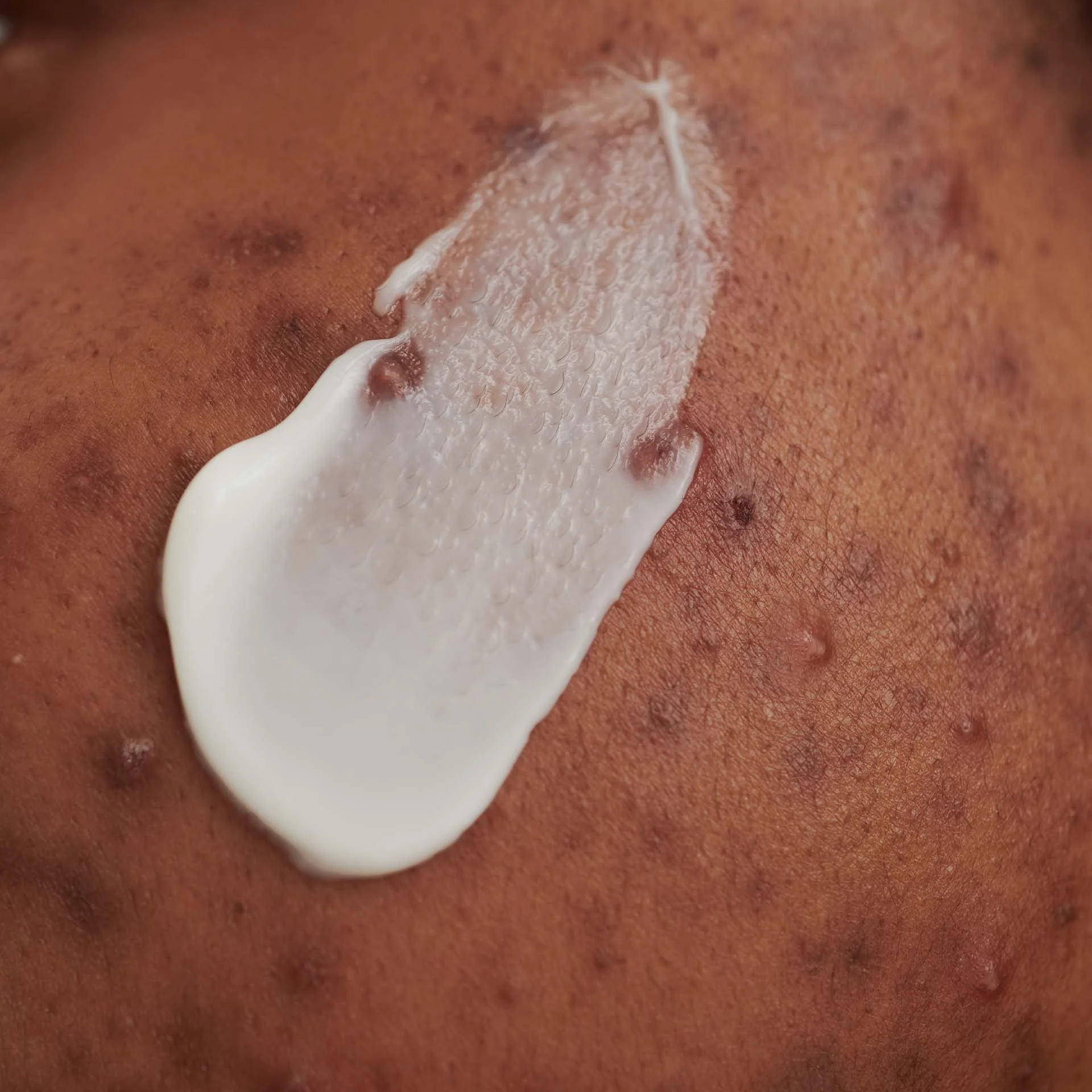 Nahaufnahme von dunkler Haut mit Akne und aufgetragener weißer DADO SENS Waschcreme-Textur