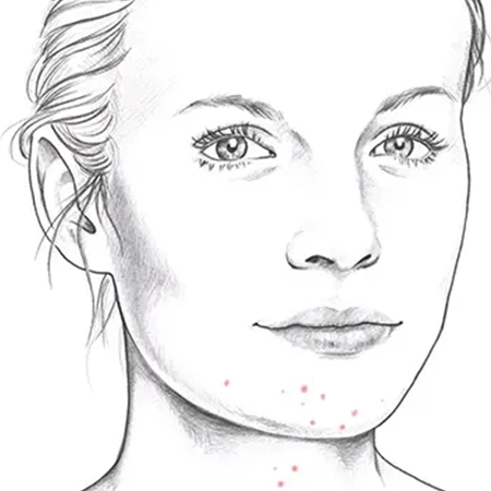 Spätakne Zeichnung eines weiblichen Gesichts mit typischer Spätakne im Kinn- und Unterkieferbereich markiert.