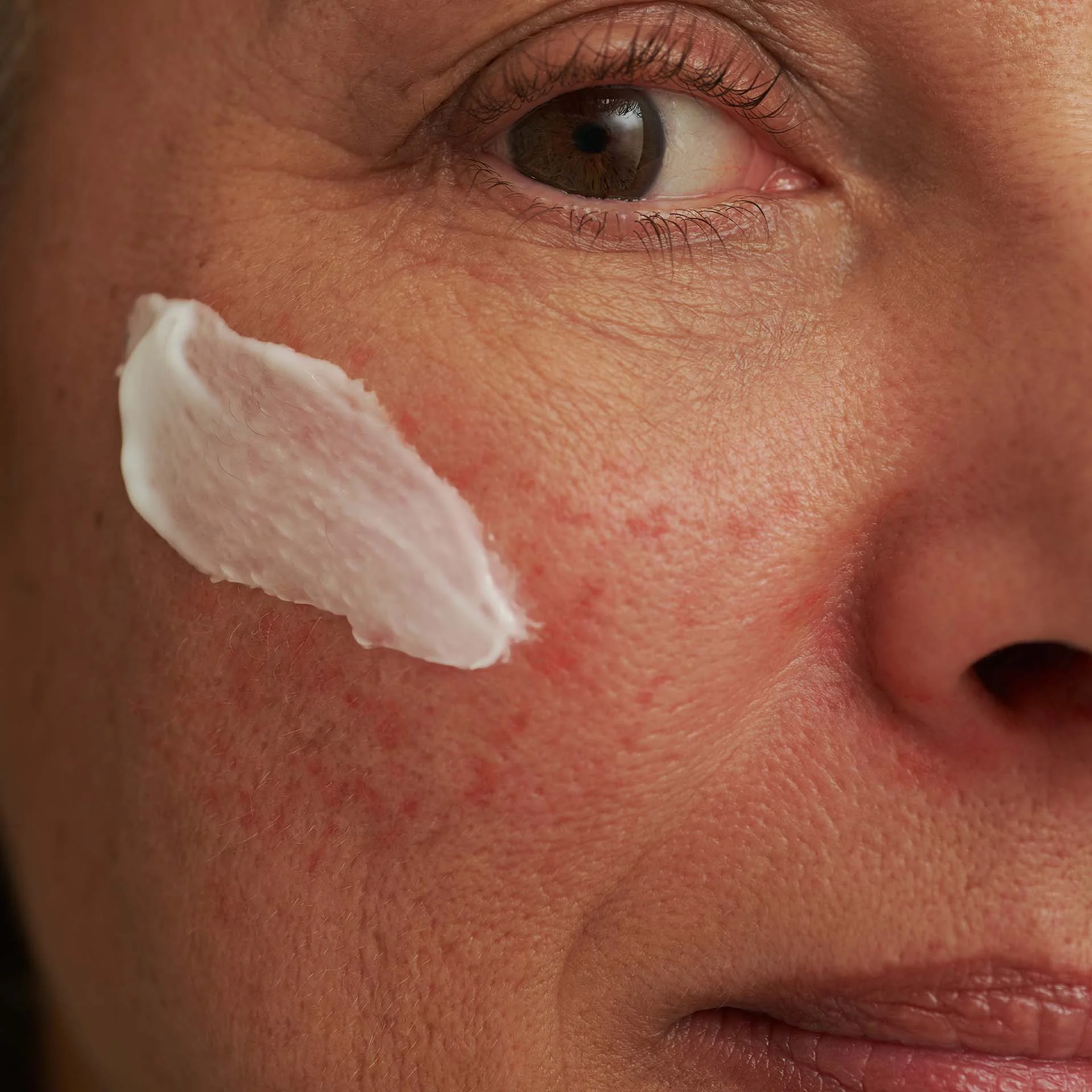 Nahaufnahme eines Gesichts mit Rötungen und weißer Gesichtsmaske auf der Wange, Hautstruktur sichtbar