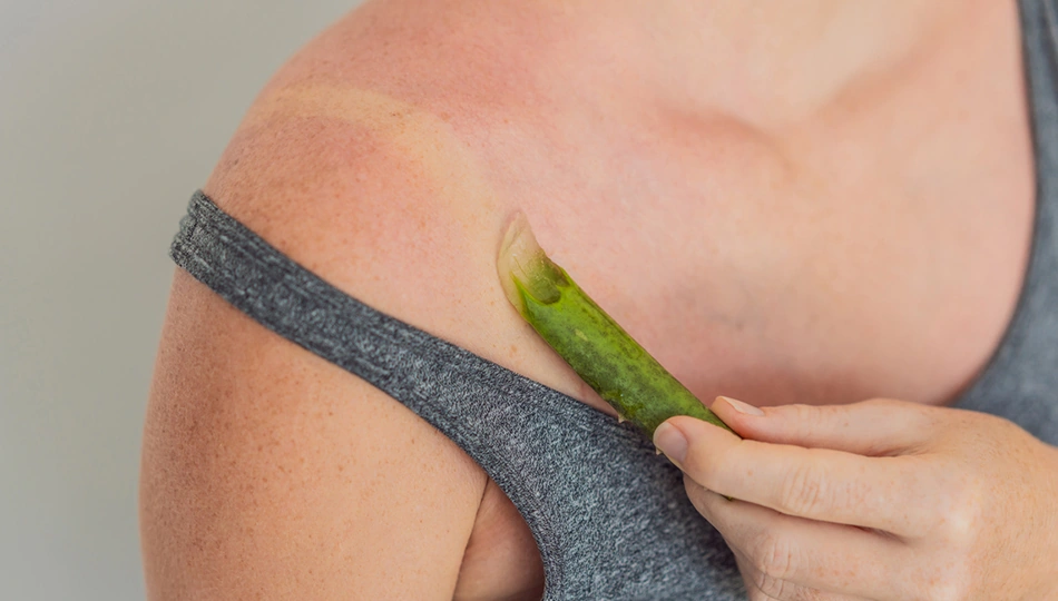 Person trägt frisches Aloe-Vera-Gel auf einen Sonnenbrand an der Schulter auf zur natürlichen Hautberuhigung.