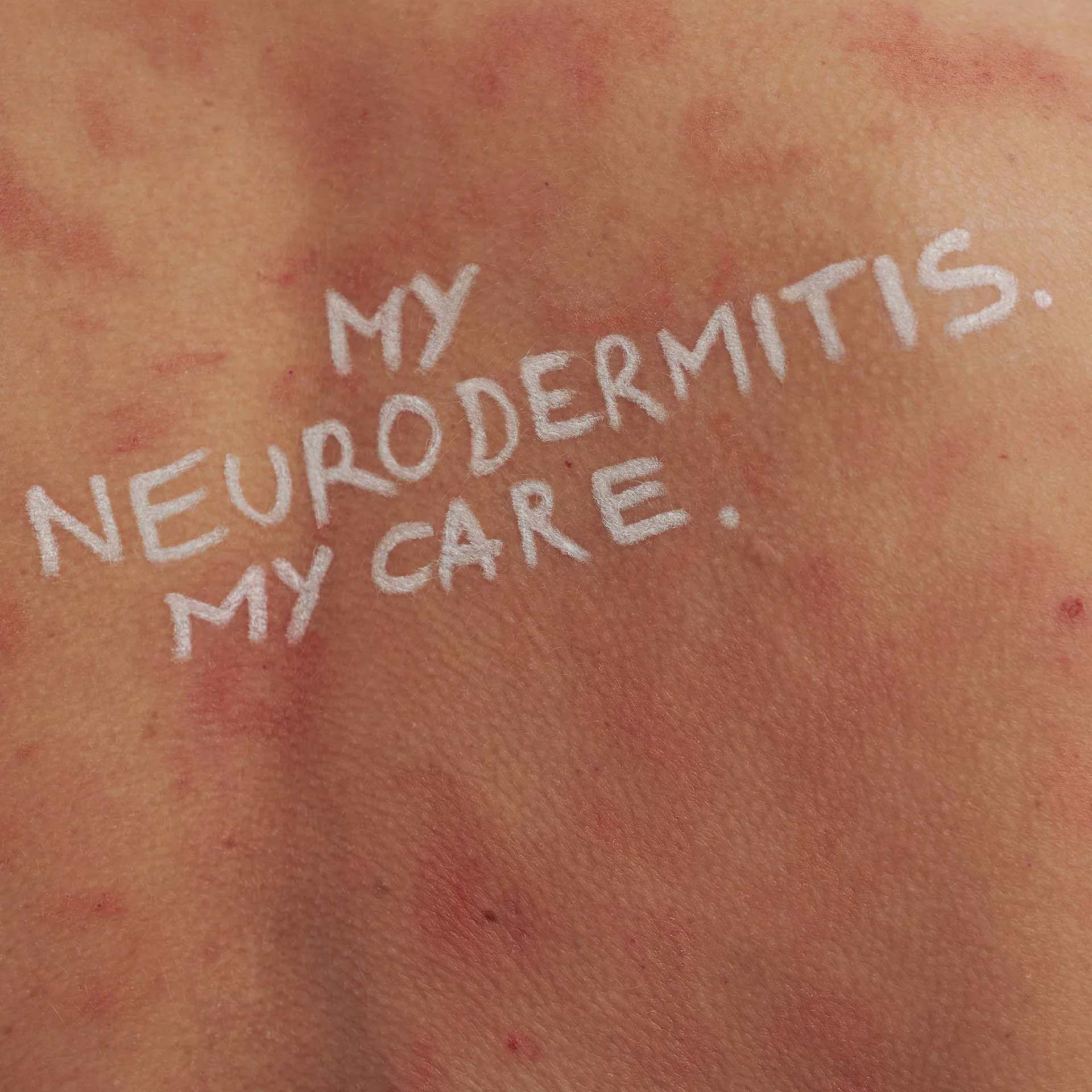 Rötungen und Hautirritationen auf Rücken mit weißer Schrift "MY NEURODERMITIS. MY CARE.