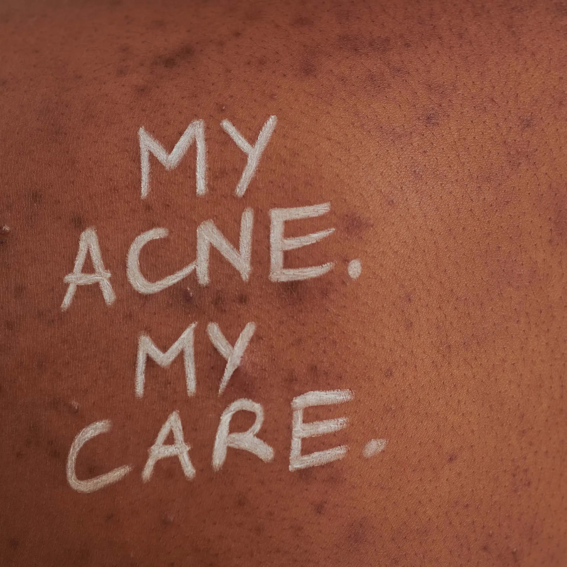 Dunkle Haut mit Akne und der Schriftzug „MY ACNE. MY CARE.“ in weißer Kreide auf der Haut
