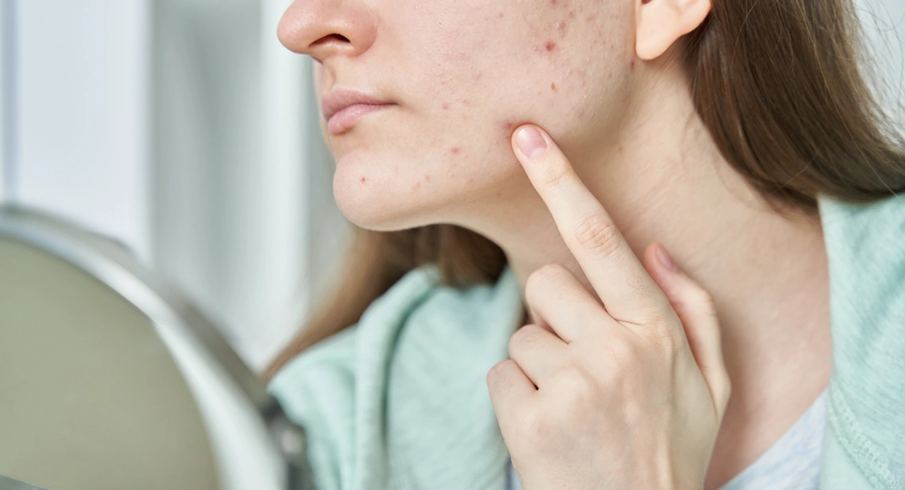 Spätakne Frau mit unreiner Haut im Kinn- und Wangenbereich betrachtet ihre Spätakne im Spiegel.